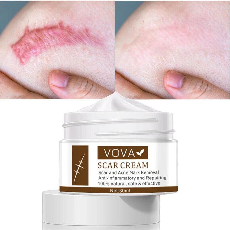 VOVA | Scar Cream - Natural Scar Removal Skin Repair Anti-Inflammatory 30ml - Better Savings Group