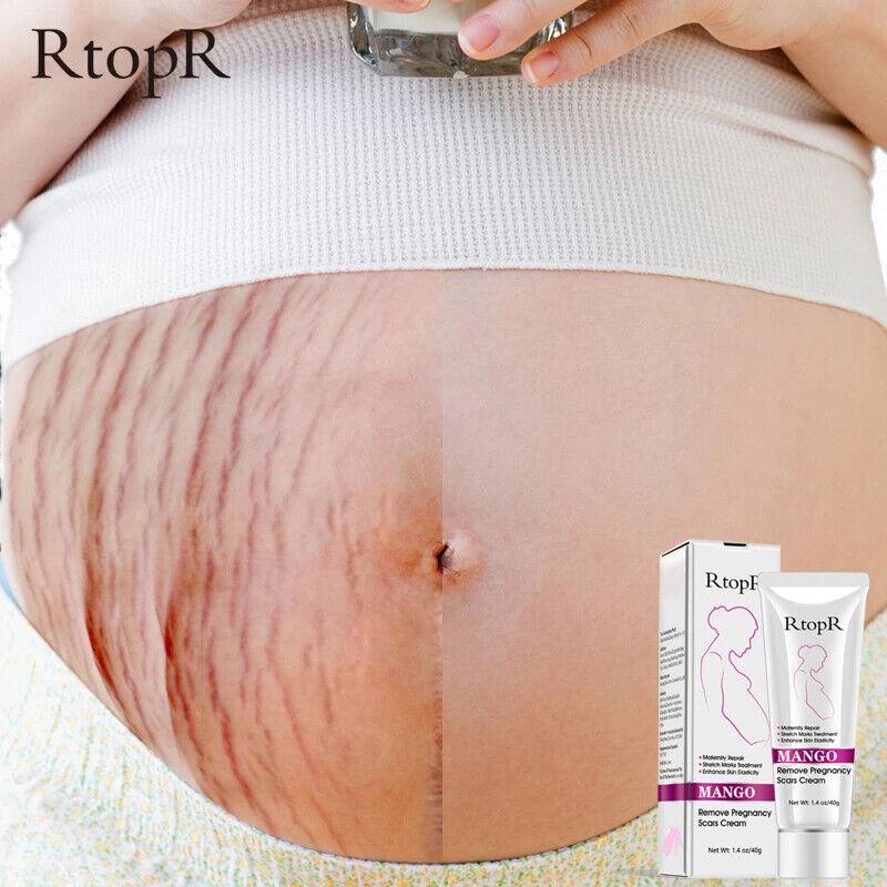 RtopR | Mango Pregnancy Scar Cream Stretch Marks Maternity Repair Firming - 40g - Better Savings Group