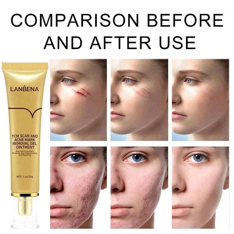 LANBENA | Skin Care Gel with TCM - Scar & Acne Mark Removal Gel Ointment - 30g - Better Savings Group