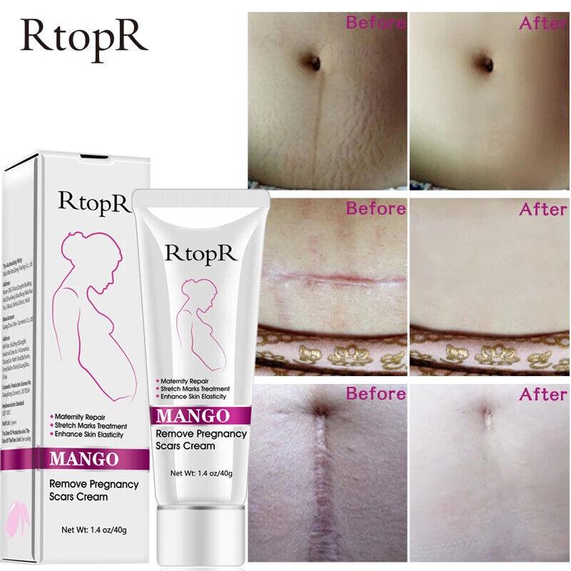 RtopR | Mango Pregnancy Scar Cream Stretch Marks Maternity Repair Firming - 40g - Better Savings Group