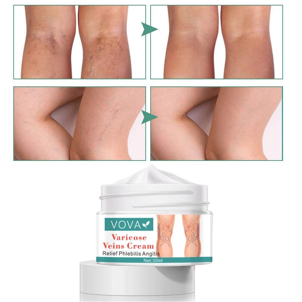 VOVA | Varicose Veins Cream - Reduce Vein Scar Treatment Skin Repair Smooth 30ml - Better Savings Group