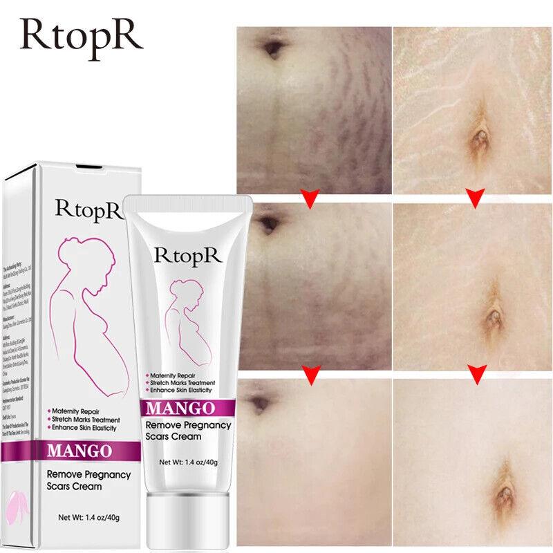 RtopR | Mango Pregnancy Scar Cream Stretch Marks Maternity Repair Firming - 40g - Better Savings Group