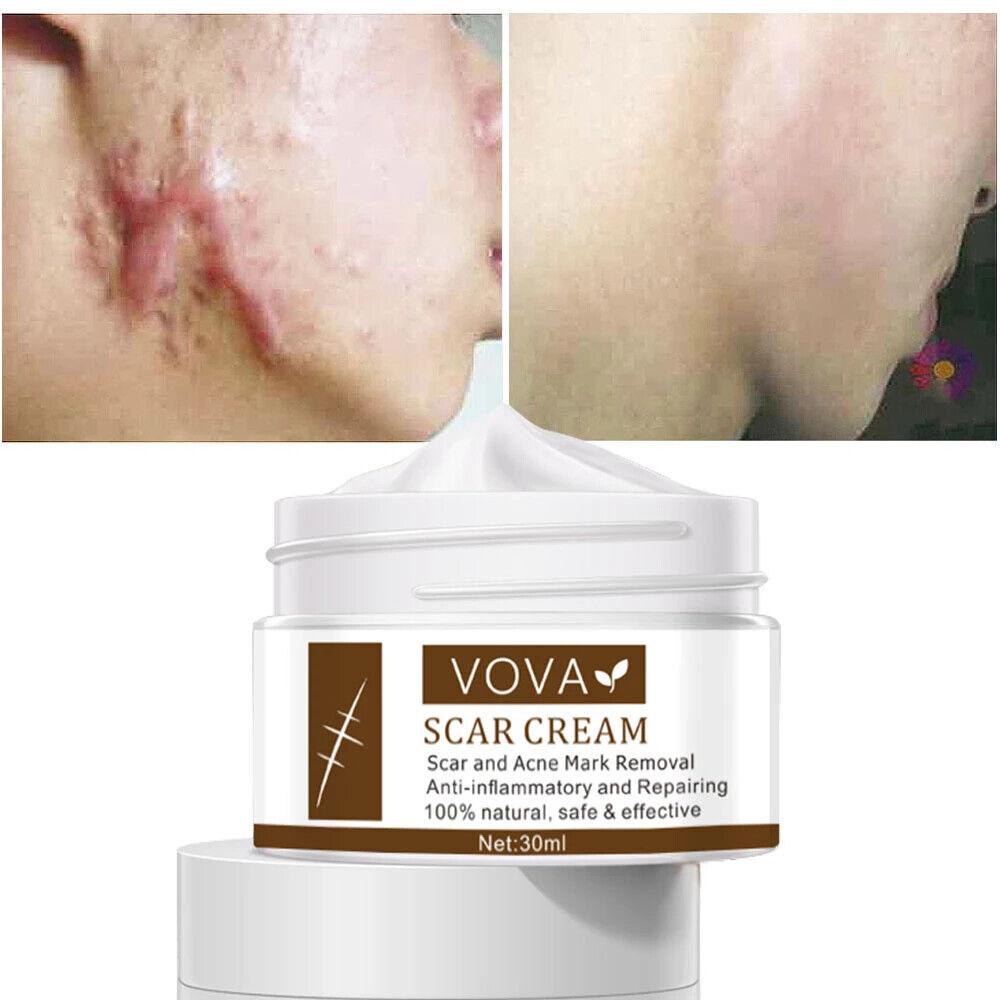 VOVA | Scar Cream - Natural Scar Removal Skin Repair Anti-Inflammatory 30ml - Better Savings Group