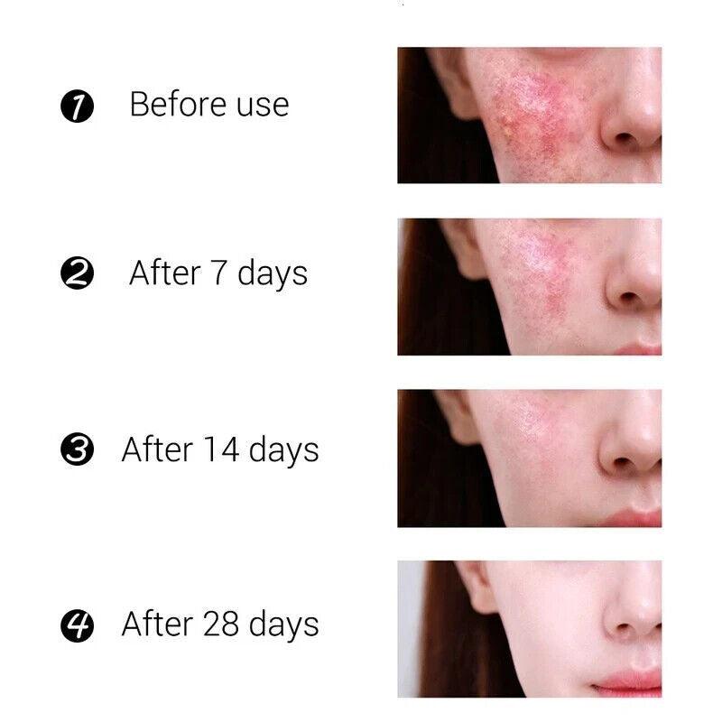 VOVA | Anti-Acne Nature Effective Pure Skin Cream - Stop Breakouts Scarring - Better Savings Group