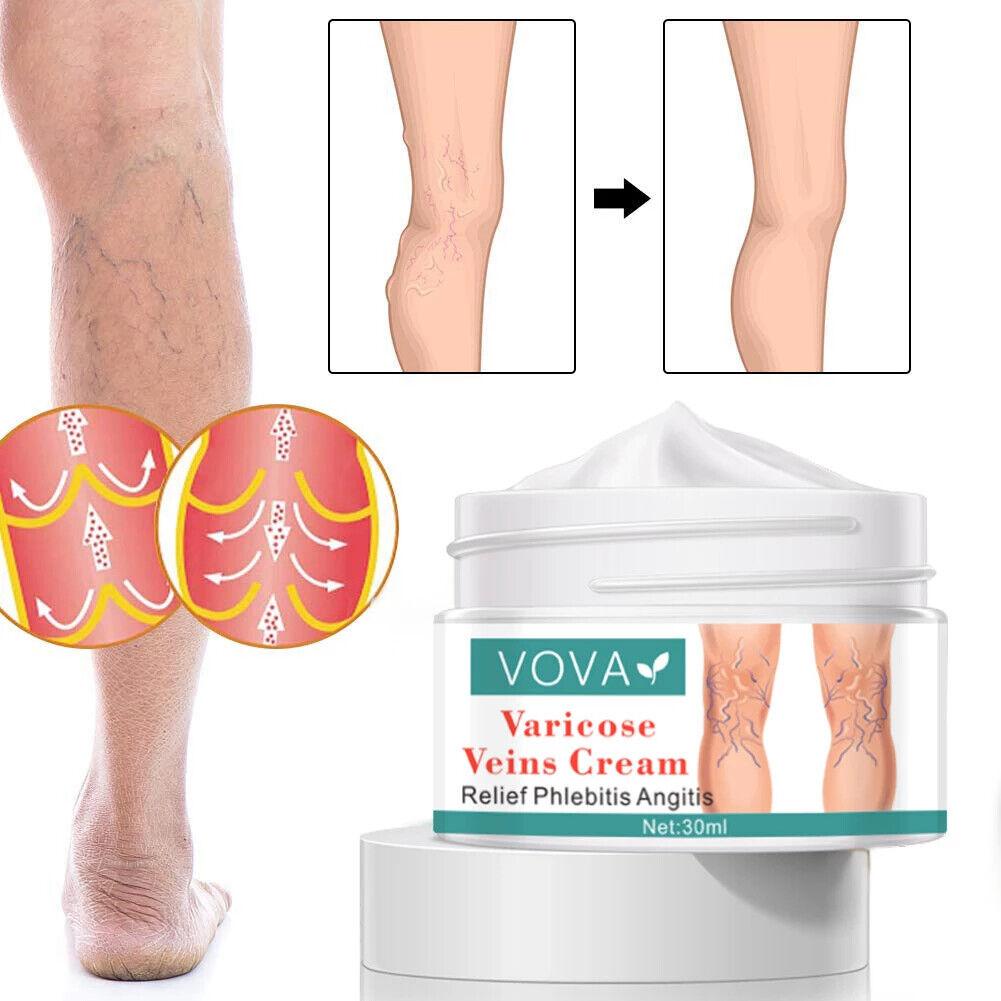 VOVA | Varicose Veins Cream - Reduce Vein Scar Treatment Skin Repair Smooth 30ml - Better Savings Group