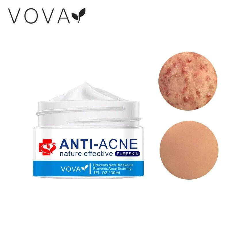 VOVA | Anti-Acne Nature Effective Pure Skin Cream - Stop Breakouts Scarring - Better Savings Group